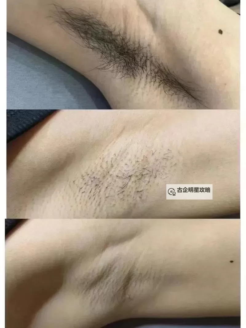 永久脱毛网:光与时间的无声对话图1